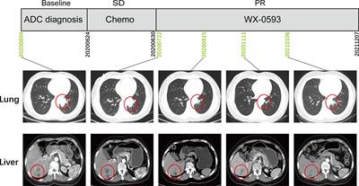 A Novel Intergenic Gene Between SLC8A1 and PKDCC-ALK Fusion Responds to ALK TKI WX-0593 in Lung Adenocarcinoma: A Case Report